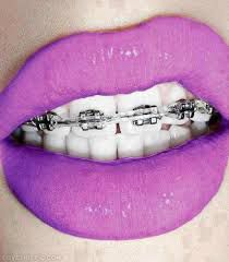 What Colour Train Track Braces Should You Get Quiz What color braces should i get? what colour train track braces should